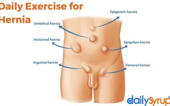 Daily Exercise for Hernia