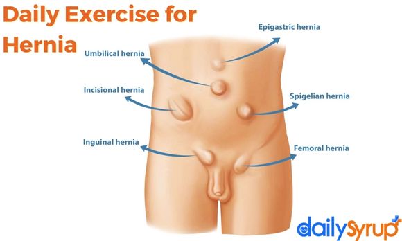 Daily Exercise for Hernia